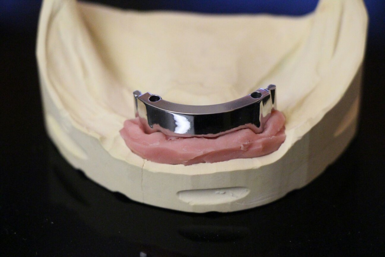 Gefräster Implantatsteg auf Camlog-Implantaten